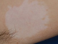 Před ošetřením vitiliga